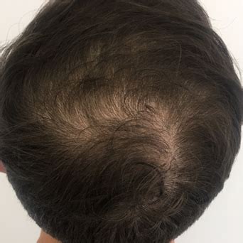 Despite being arguably one of the strongest people on the server, purpled is a relatively passive person. Scalp Micropigmentation (SMP) HairTransplant in Melbourne ...