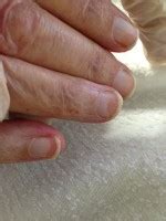 Leukonychia (white nails) occurs in several forms: Witte vlekjes op de nagel: leukonychia oorzaak en ...