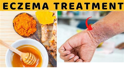 They use otc remedies they can get in a drugstore. How to Cure Eczema Permanently Fast Naturally At Home ...