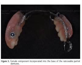 A partial denture is attached by clasps to the teeth and is easily removed by the patient. Implant-supported removable partial denture