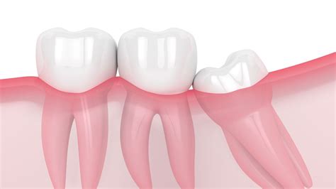 It's best if you don't brush for an hour or more after eating, especially if you've had some high acid foods like citrus, soda, or sugary foods. How Soon Can You Eat After Wisdom Teeth Removal? | CARDS ...