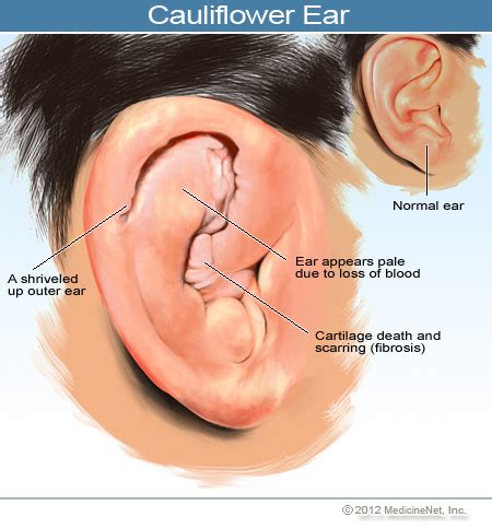 When blood flow is blocked, the affected cartilage may die and, without the supportive tissue, fold in on itself. The Cauliflower Ear | Gracie Barra