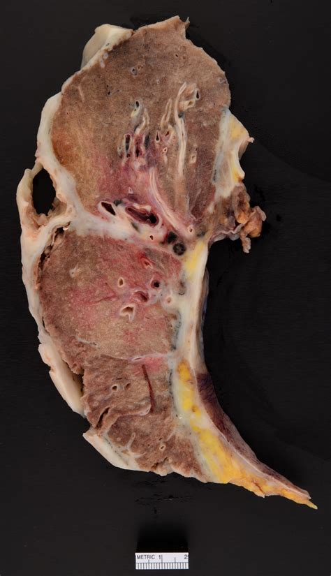 Histology is necessary for differentiating between mesothelioma and other types of cancer. Pathology Outlines - Diffuse malignant mesothelioma