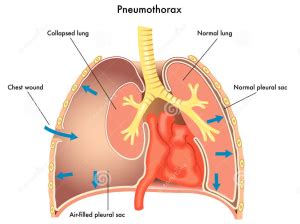 A pneumothorax can be caused by: What is hypoxia? A first aid guide - First aid for free