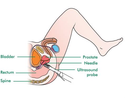 Stress, parasites, diet and infectious. Trans-rectal ultrasound scan (TRUS) biopsy - Macmillan ...