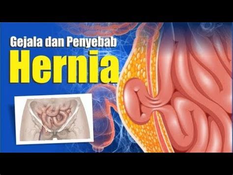 Cara Menyembuhkan Hernia Tanpa Efek Samping - YouTube