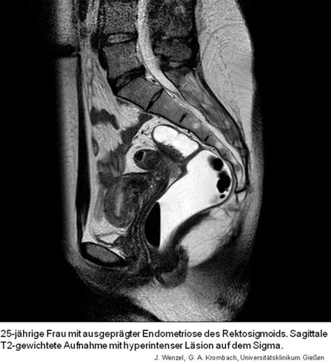 Welche symptome und folgen das haben kann und wie die erkrankung behandelt wird, lesen sie hier! Schonende Diagnose der Endometriose - MRT spürt ...