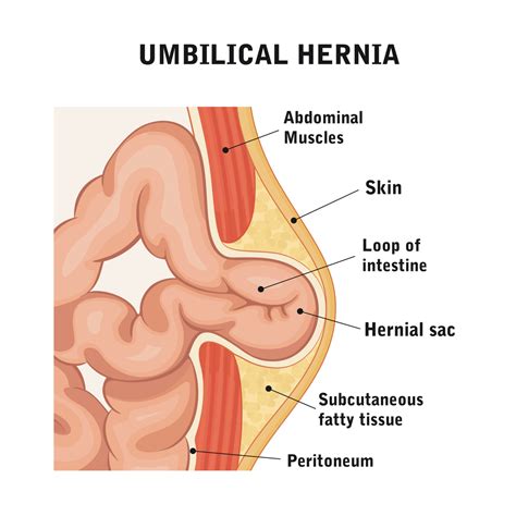 It occurs through the belly button. Umbilical Hernia Repair | Hernia Surgeons | Detroit Michigan
