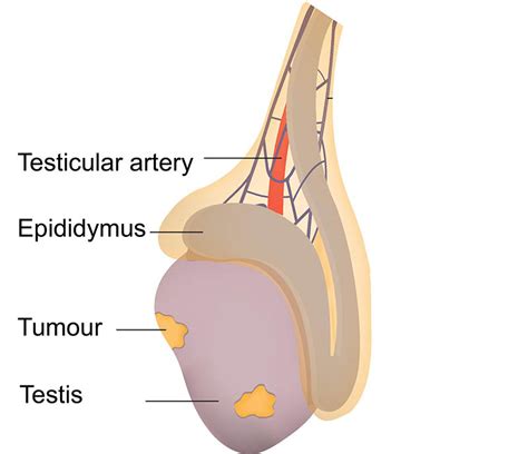 Most testicular cancers are germ cell (cells that produce sperm) tumors. Testicular cancer kidney, Ureterocele | Children's National