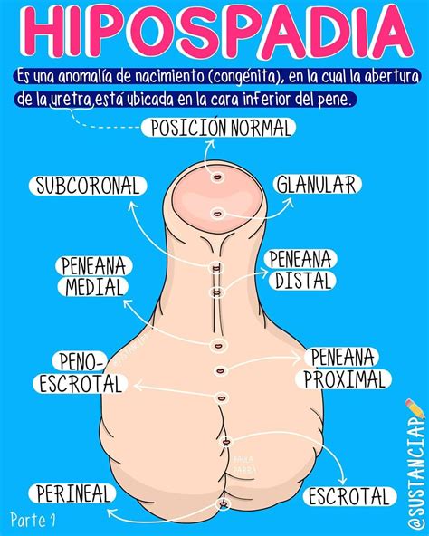 Hipospadias çocukluk yaşta onarılması gereken doğumsal bir anomalidir. Por:Paula Parra Díaz @sustanciap Instagram www.sustanciap.com | Anatomia y fisiologia humana ...
