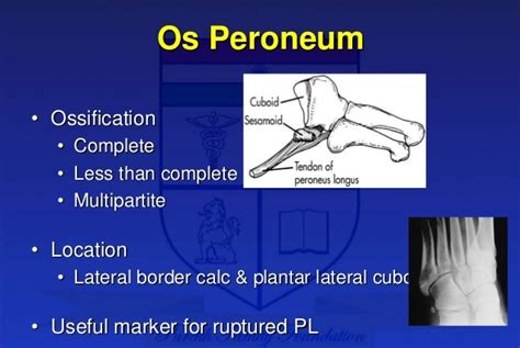 Find out all about peronei : 비 부골(Os peroneum, Os peronei) : 런닝을 하고 있는 동안에 발의 외측이 아파요 ...