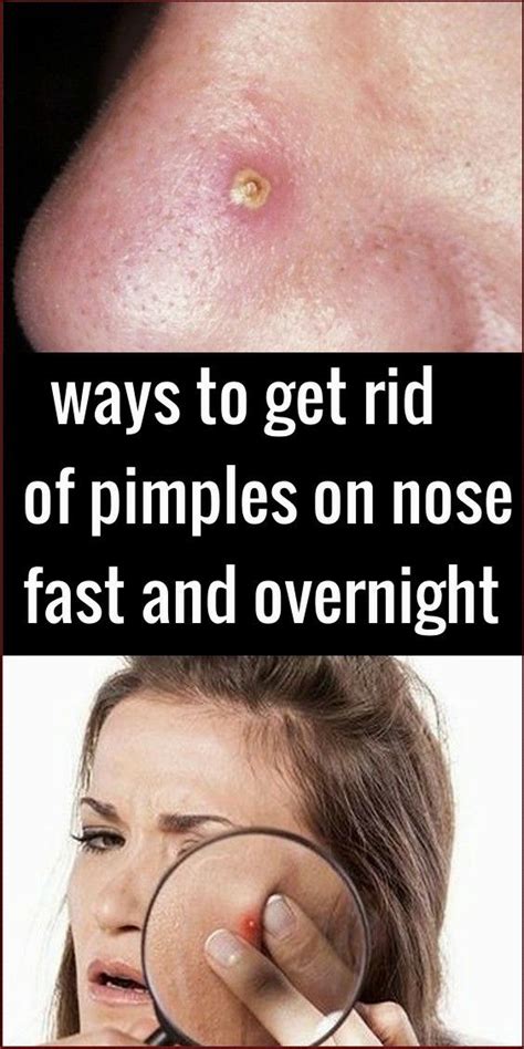 Medical and natural treatment options. ways to get rid of pimples on nose fast and overnight ...