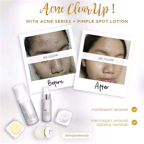 Review ms glow luminous series i review produk testimoni pemakaian akibat berhenti dari ms glow. Testimoni pemakaian acne series ms glow | Ms Glow Skincare ...