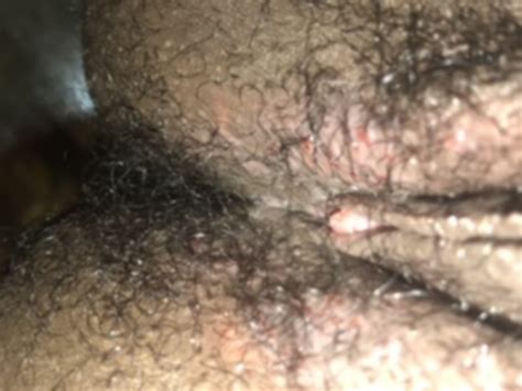 This undesirable growth pattern of a hair growing back into the skin is more likely to occur after hair removal, including shaving, tweezing or waxing. Ingrown hairs, sti, std, rash? | Genital Herpes Simplex ...