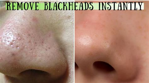 A large part of taking care of your face is making sure that you have clean pores. How to clear BLACKHEADS on nose naturally the best way ...