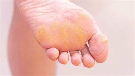 Corns & Calluses: Causes, Symptoms & Treatment | The Feet People Podiatry