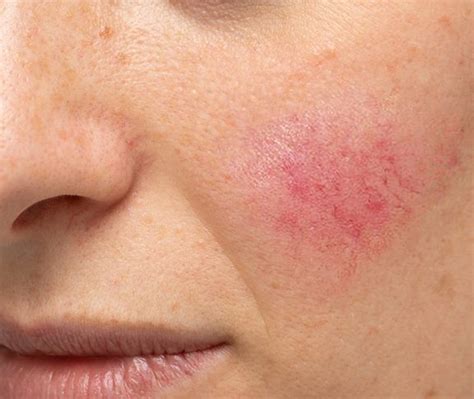 How to treat acne rosacea language:de. Das lästige Rosenblütchen - GESUNDER KÖRPER