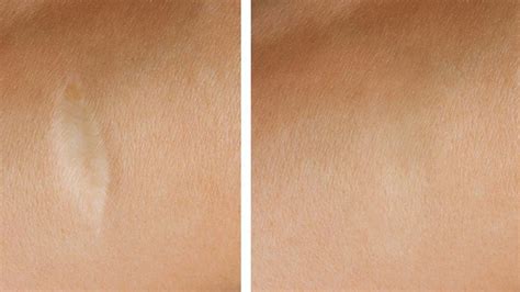 Lasern, mit hitze, elektrizität oder kälte behandeln, operatives entfernen und mit hilfe chemischer oder natürlicher mittel abtragen: Narben Pigmentation Remscheid