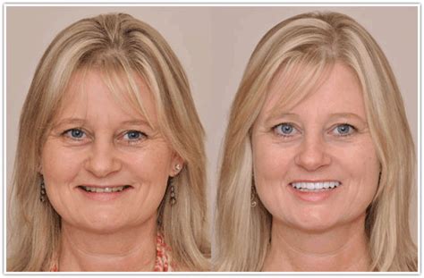 But how can you know if you're dealing with a situation that. Dental Facelift Corrects TMJ and Overbite | Face lift ...