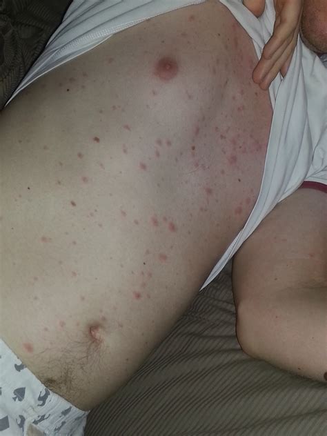 The moderna vaccine is recommended for people aged 18 years and older. Seeing Spots: Julian's Chickenpox Story - The Vaccine Mom
