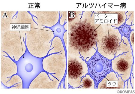 【公式サイト限定】 素直になれない恋人たち 4th season 橘聖人ブロマイドセット. アルツハイマー病の新しい画像検査 ～病因物質、ベーター ...