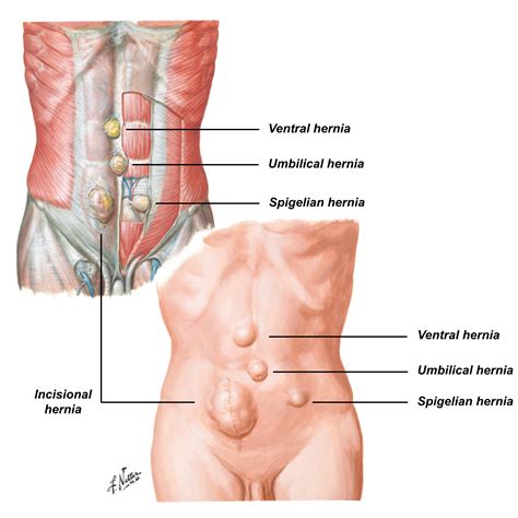 Not everyone with a hiatus. Abdominal hernia. Causes, symptoms, treatment Abdominal hernia