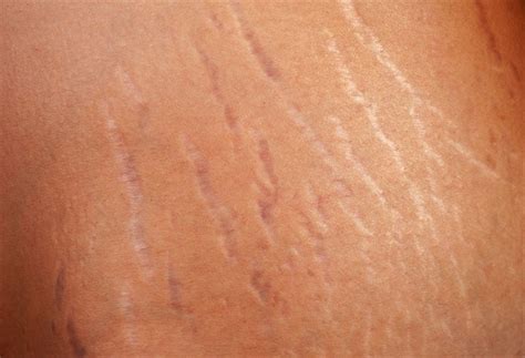 Cara menghilangkan jerawat dengan menggunakan lidah buaya untuk menghilangkan jerawat adalah kerok gel lidah buaya secara langsung dengan menggunakan sendok. MACAM MANA NAK HILANGKAN STRETCH MARK PADA KULIT?