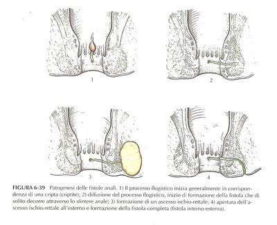 Mp4 480p, 79.92 mb mp4 720p, 127.89 mb. Dott. Andrea Straniero: Ascessi e Fistole anali