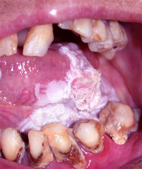 Rug leukoplakia of the mouth is remarkable that the most common, and its «victims» are elderly the mucous membrane of the mouth pliable in the case of leukoplakia and the man may be a long time to. Print HEENT flashcards | Easy Notecards