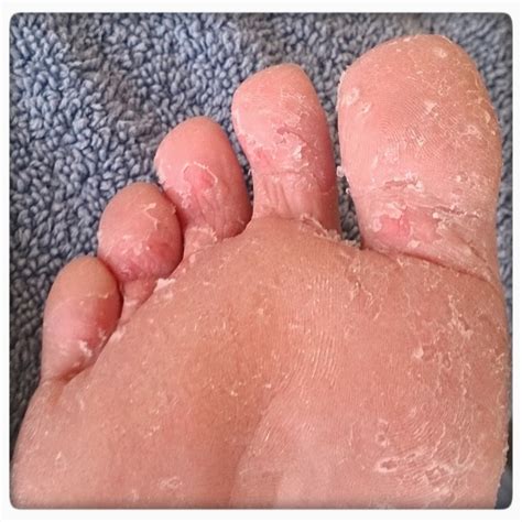 Maybe you would like to learn more about one of these? Do You Have Itchy Feet? - Almawi Limited The Holistic Clinic