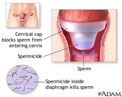 Is it boring being at level cap or is the game still. Cervical Cap - Sexual HealthTalk for Teens