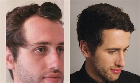 Im mittelpunkt all unserer angebote und aktivitäten steht stets der gesunde mensch. Haartransplantation Forum: Anbieter Haartransplantation ...