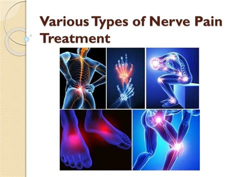 Three types of nerve injuries. PPT - Various Types of Nerve Pain Treatment PowerPoint ...