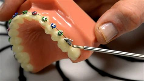 How to use orthodontic wax. Wax: A Great Temporary Fix for Braces with Poking Wire ...