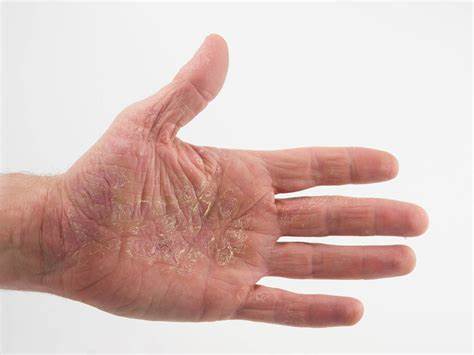 Дерматит симптомы диета Экзема и дерматит. Чем отличаются эти заболевания? Экзема и дерматит. Чем отличаются эти заболевания? Дерматит симптомы диета