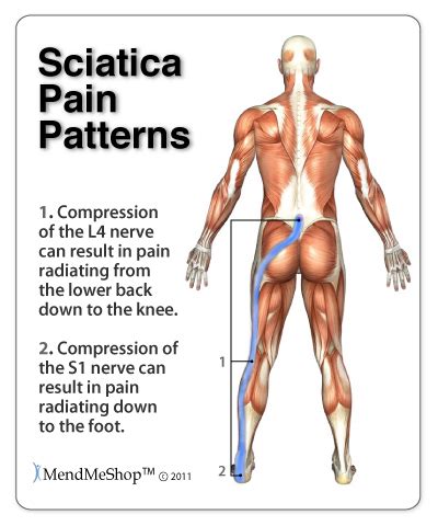 Hip abduction, flexion and med. Sciatica Overview