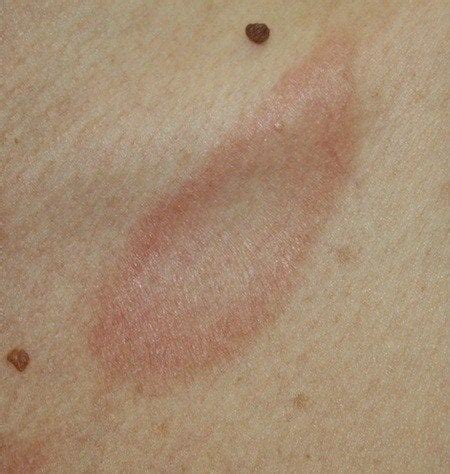 Foto macchia rossa sul glande. La Pitiriasi Rosea di Gibert: la guida completa per la ...