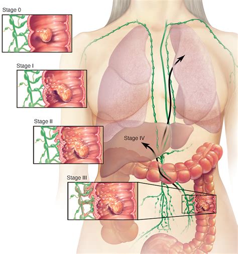 At later stages, symptoms tend to vary based on tumor size and location in your large intestine. Colon Cancer Causes, Signs, Symptoms, Stages, Screening ...