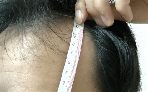 Lovely M 字はげ 生まれつき Tatoo Design One Point