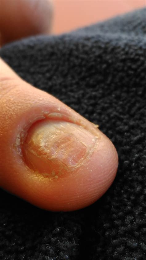 What makes fingernails grow faster? Seriously people, what can I do? Remove the nail and let ...