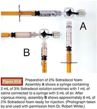 Sotradecol sclerotherapy appears to be a useful adjunct to the therapeutic arsenal for orbital to describe the results of intralesional injection of the sclerosing agent sodium tetradecyl sulfate in. Varicocele - Clinical Applications - Embolization Therapy ...