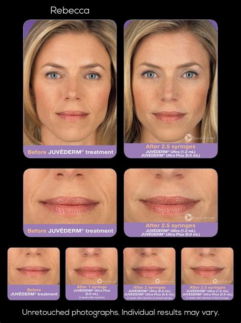 Juvederm volbella is perfect for lip enhancement and for fil. Premier ENT Cosmetics Injectable Fillers | Premier ENT ...