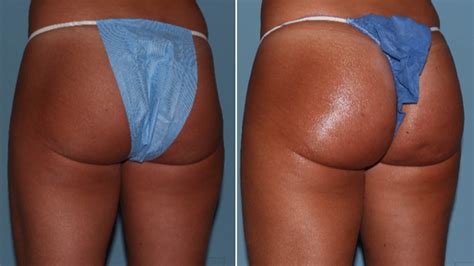 If you're constantly sitting and never exercising, then your buttocks might get smaller, but only because the muscle would be replaced with fat. Non-Surgical Butt Lifts Are the New Plastic Surgery Trend ...