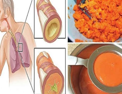 Tanyakan ahli farmasi atau doktor anda tentang shampu yang mengandungi ketoconazole. Ubat Batuk Kahak Di Farmasi - Deepavalih