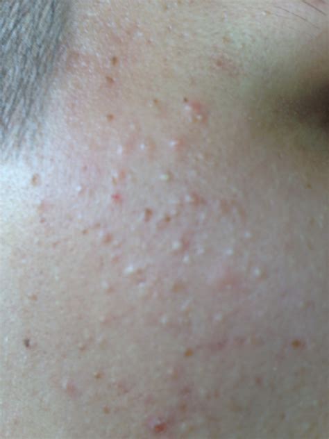 Sind allergien für die bindehautentzündung verantwortlich, sind typische symptome juckende augen, lidschwellungen und augenbrennen. michaelfranklinns: Lebensmittelallergie Pickel Im Gesicht