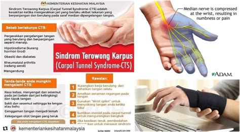 Punca tangan kebas boleh jadi sama atau berbeza untuk setiap orang. Carpal Tunnel Syndrome: Punca Kebas Tangan, Senaman & Rawatan