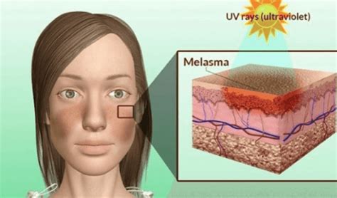 Dicha afección consiste en la presencia de diversas manchas por toda la cara y al ser de color oscuro dan una. Melasma | Josep Bertó