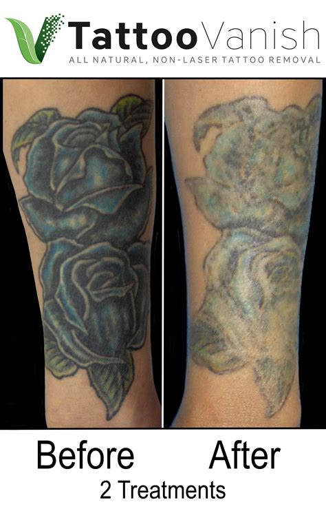 Different wavelengths of light will target different tattoo colours. Best Tattoo Removal in Miami | All-Natural & Non-Laser ...