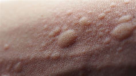 This hives rash also known as dermatographism first appeared in march 1997. Hives (Urticaria) - Symptoms, Causes, Treatment and Photos