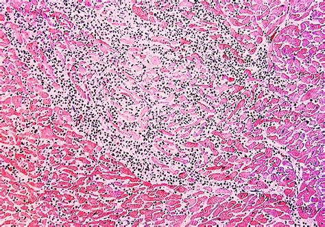 Consenso de expertos sobre el manejo de la miocarditis aguda y las cardiomiopatías inflamatorias. HISTOPATOLOGIA FORENSE PRACTICA (FORENSIC PATHOLOGY FORUM ...